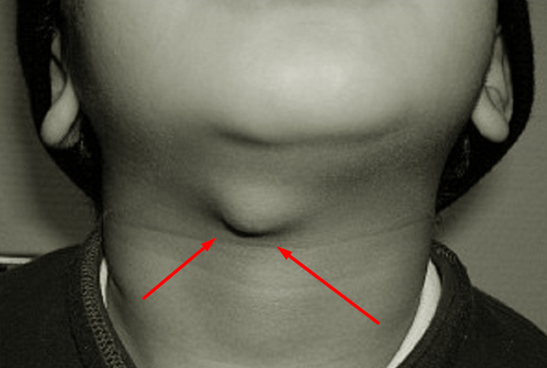 Obat Alami Benjolan Dibawah Dagu