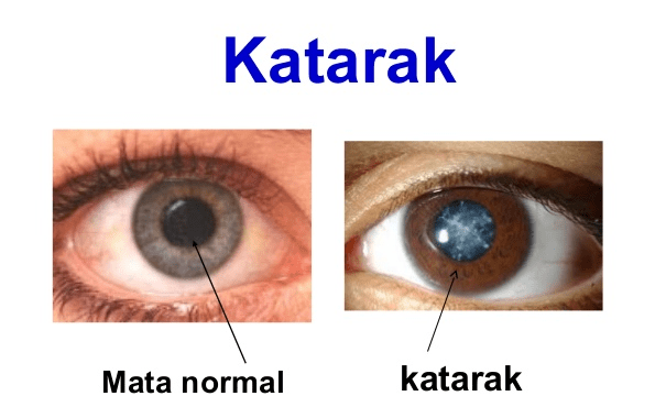 Obat Mata Katarak Alami Tanpa Operasi