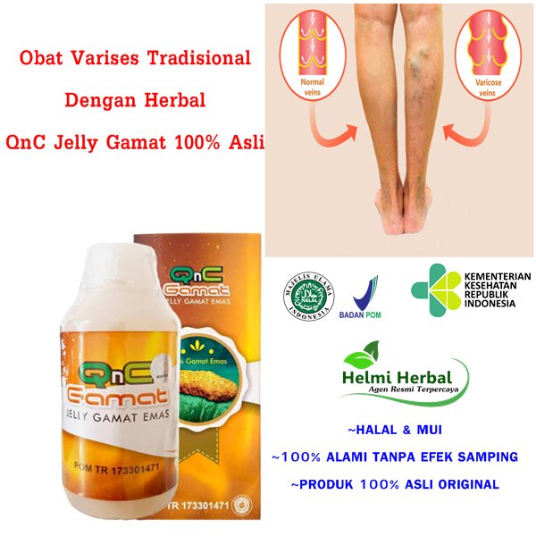 Obat Varises Tradisional