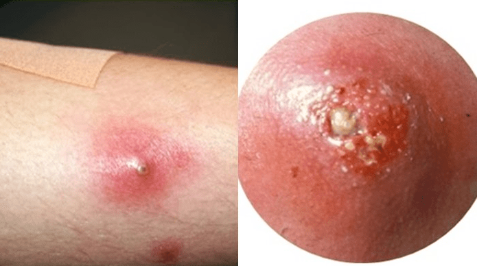 Obat Bisul Alami Paling Ampuh