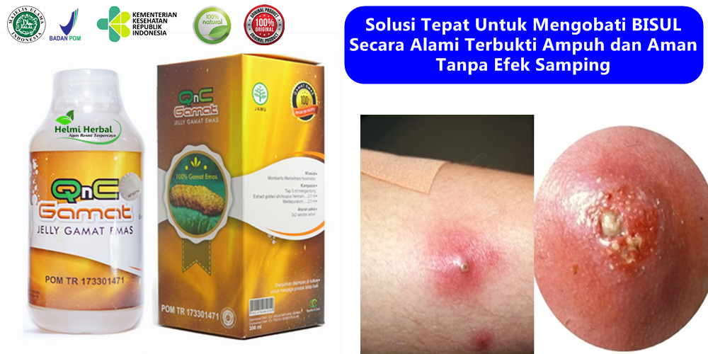 Obat Bisul Alami Paling Ampuh
