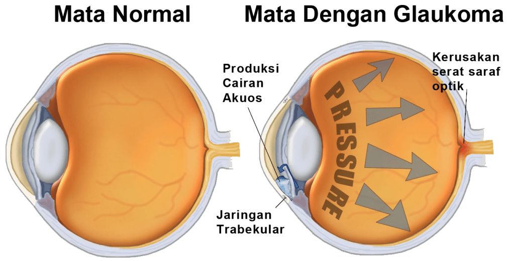 Obat Glaukoma Alami Tanpa Operas