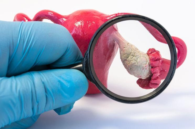 Obat Kista Ovarium Alami Paling Ampuh